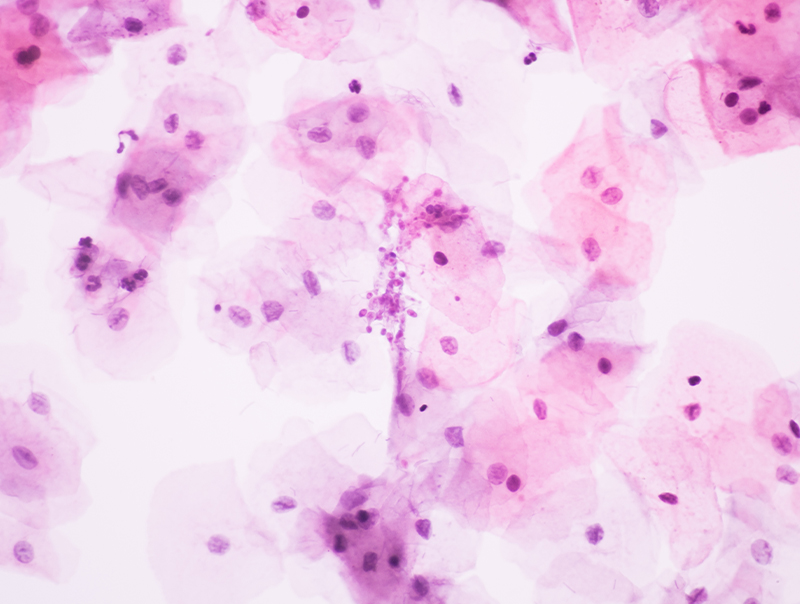 View in microscopic of Candidiasis, fungus infection (Yeast and Pseudohyphae form) in pap smear slide cytology and diagnostic by pathologist.